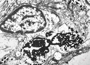 M,29y. | spleen - dyserythropoetic anemia - complex siderosomes